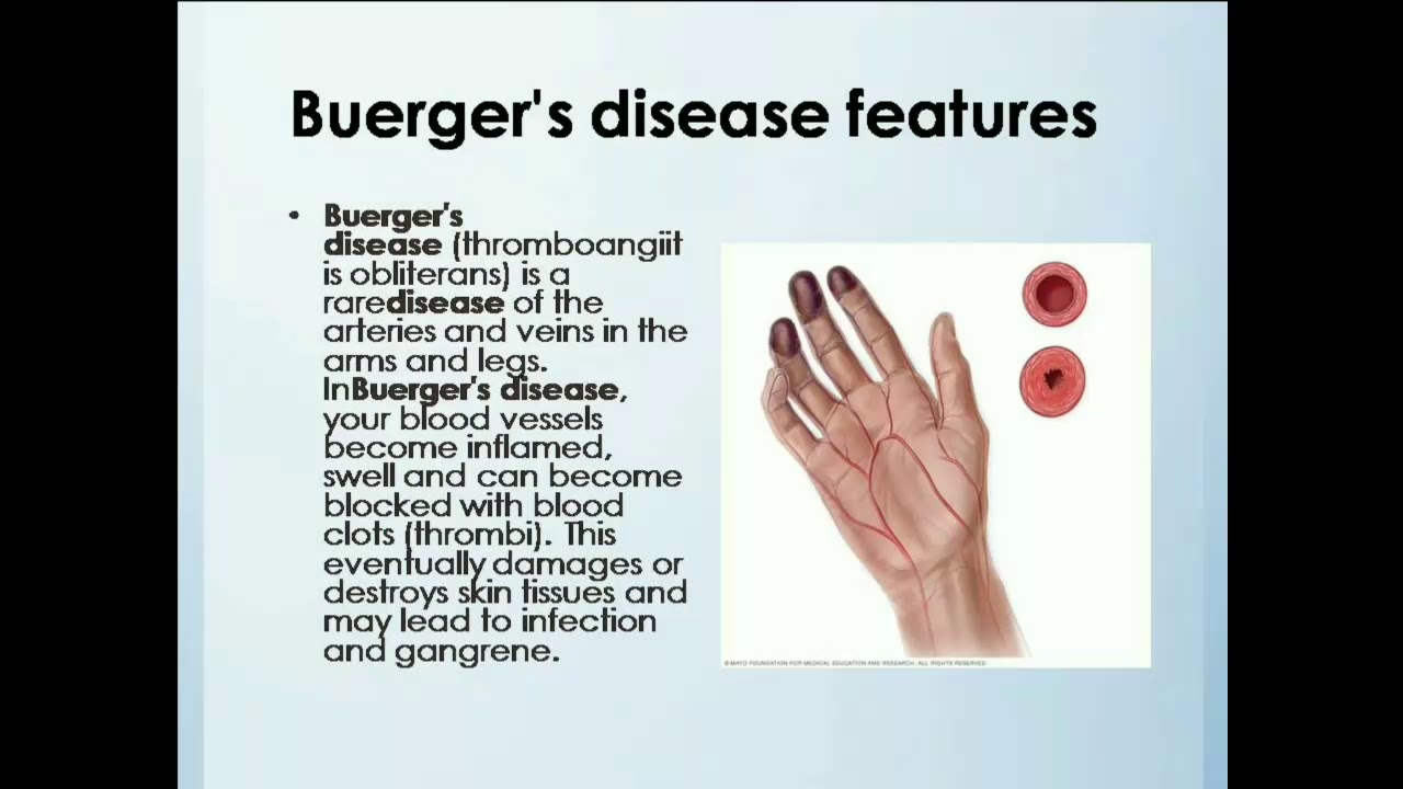 buerger 1