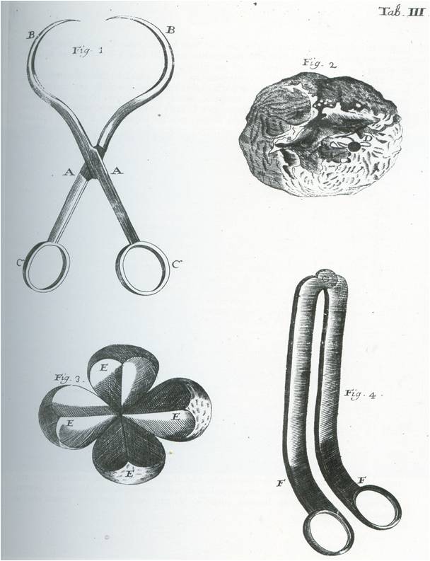 Eργαλεία μαστεκτομής, Helvetius  Biblioteca chirurgia (1721) J. J. Mangetus