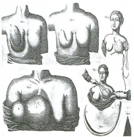 Μαστεκτομή του Heister, Medical, Chirurgical and Anatomical Cases, English Edition, 1755