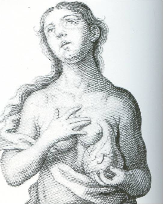 Καρκίνος μαστού  Theatro chirurgico anatomico (1729), Francisco Suarez de Riveira