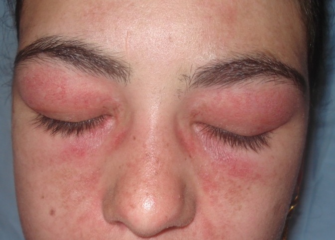 Εξάνθημα "ηλιοτρoπίου''