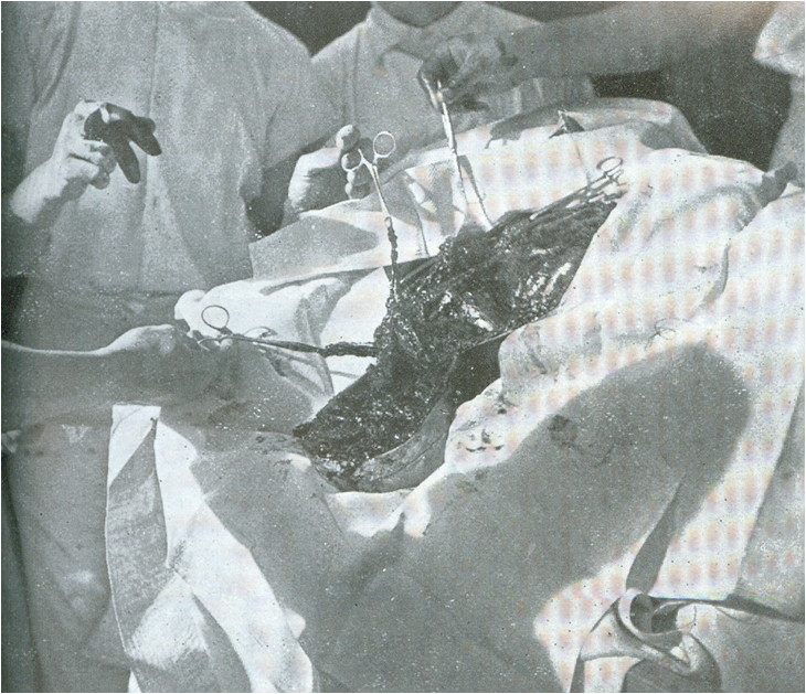 H πρώτη φωτογραφία της ριζικής μαστεκτομής κατά Halsted, που δείχνει και την χρήση των πλαστικών γαντιών στο χειρουργείο, 19ος ΑΙΩΝΑΣ