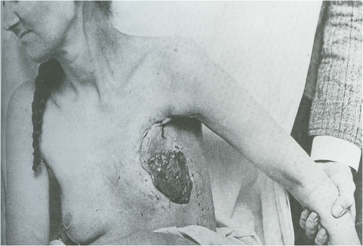 Η πρώτη δημοσιευμένη φωτογραφία του Halsted που δείχνει τραύμα ριζικής μαστεκτομής