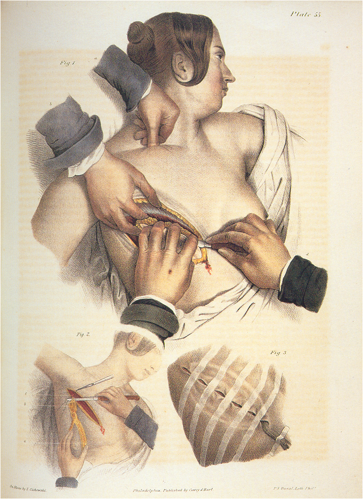 Η τεχνική της μαστεκτομής του  Pancoast  Pancoast J: Treatise on Operative Surgery,  Philadelphia, Carey and Hart, 1844.Surgery p 469