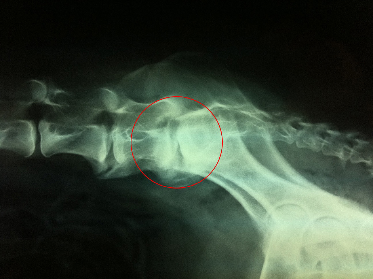 Απλή ακτινογραφία λόγω πρόπτωσης δίσκου