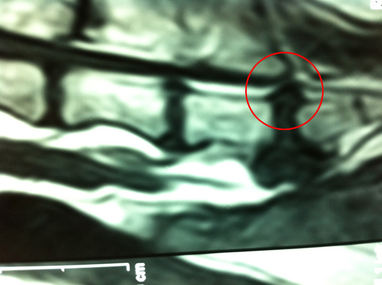 Μαγνητική τομογραφία σκύλου με οσφυοϊερό σύνδρομο λόγω πρόπτωσης δίσκου