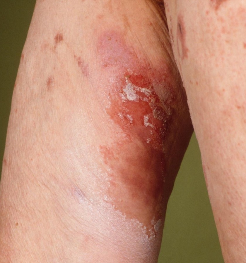 Νεκρολυτικό μεταναστευτικό ερύθημα