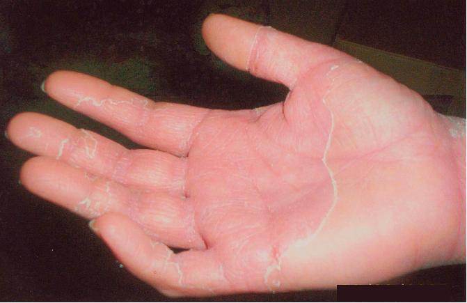 Απολεπιστική δερματίτιδα