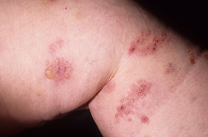 Ερπητοειδής δερματίτιδα