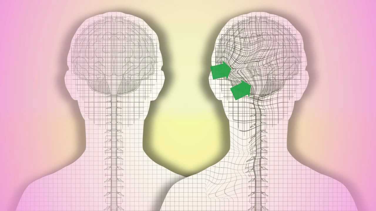 craniosarcal 5