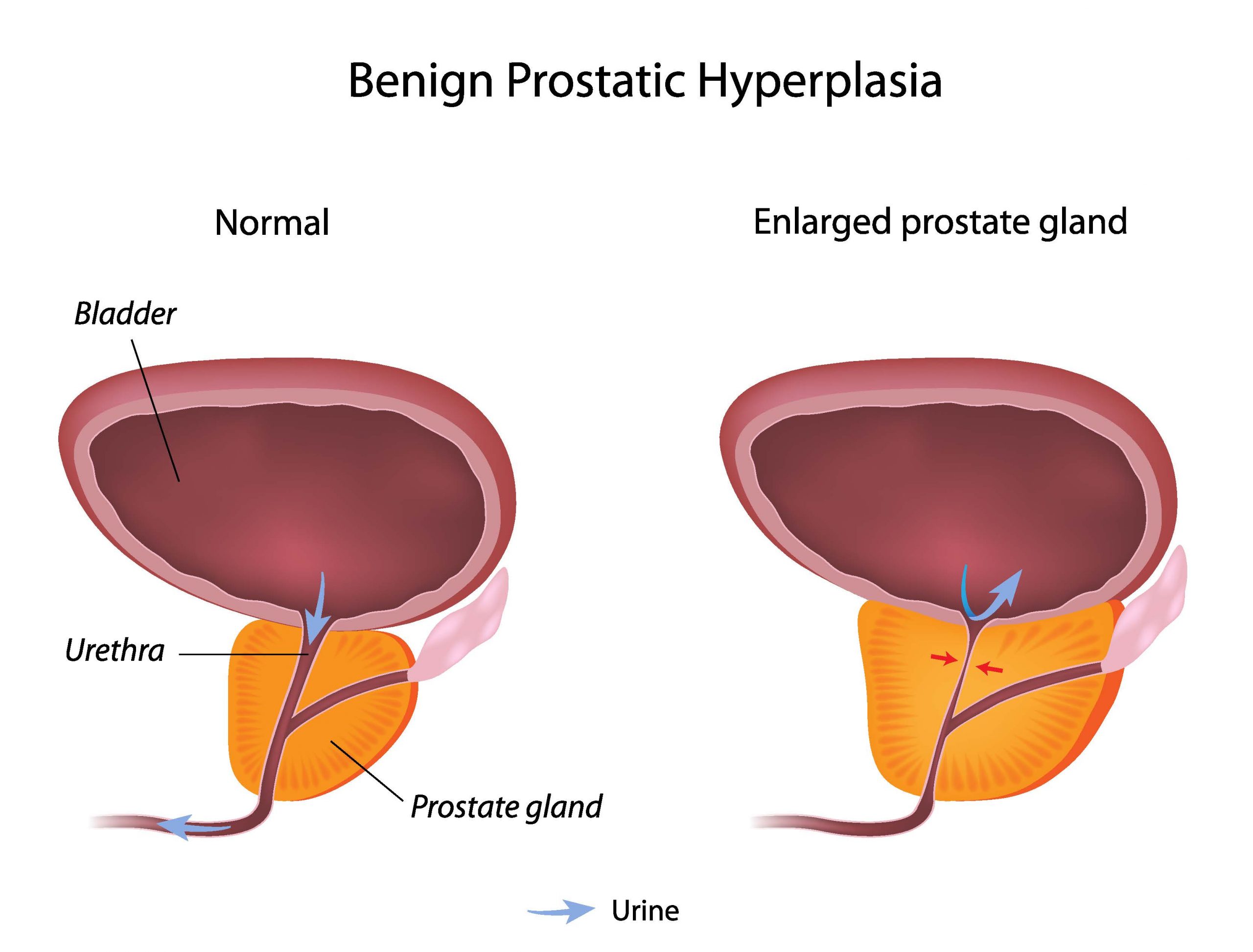 yperplasia prostati 2