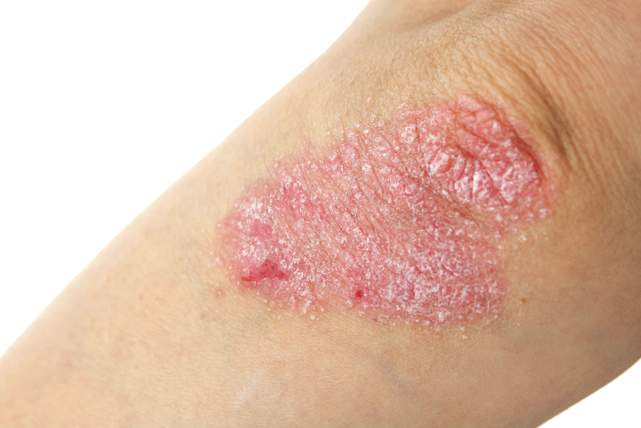 psoriasis 4