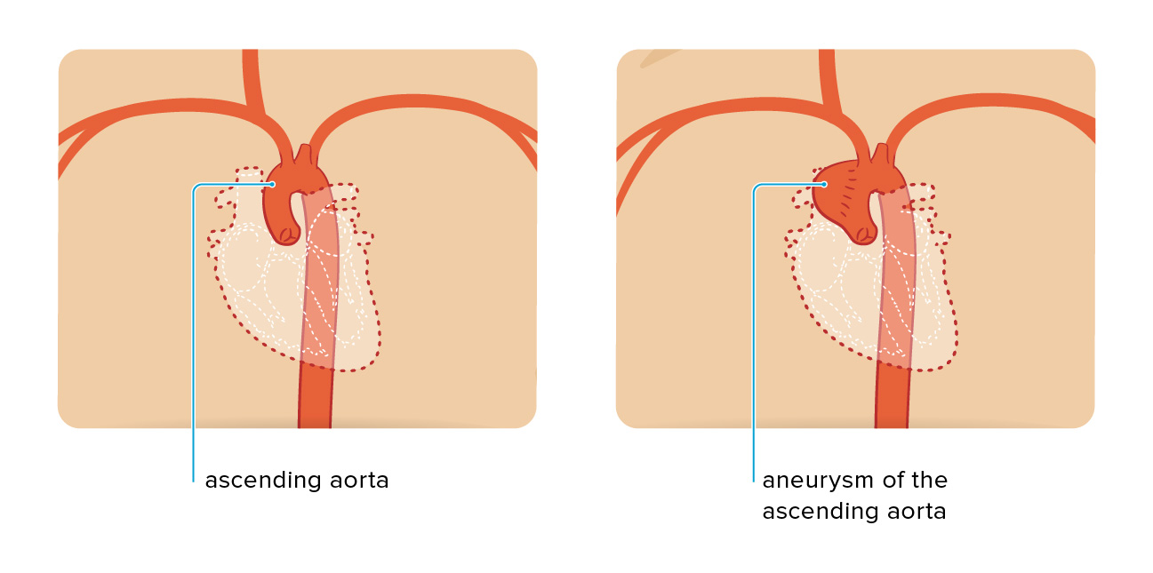 stenosis aorta 1