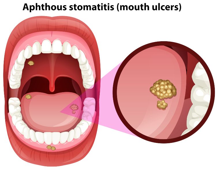 ulcers in mouth