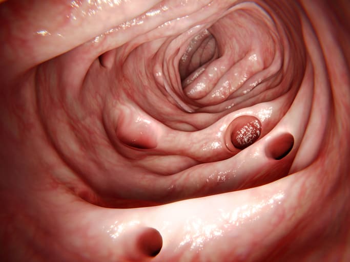 What Causes Pseudomembranous Colitis C. diff Colitis