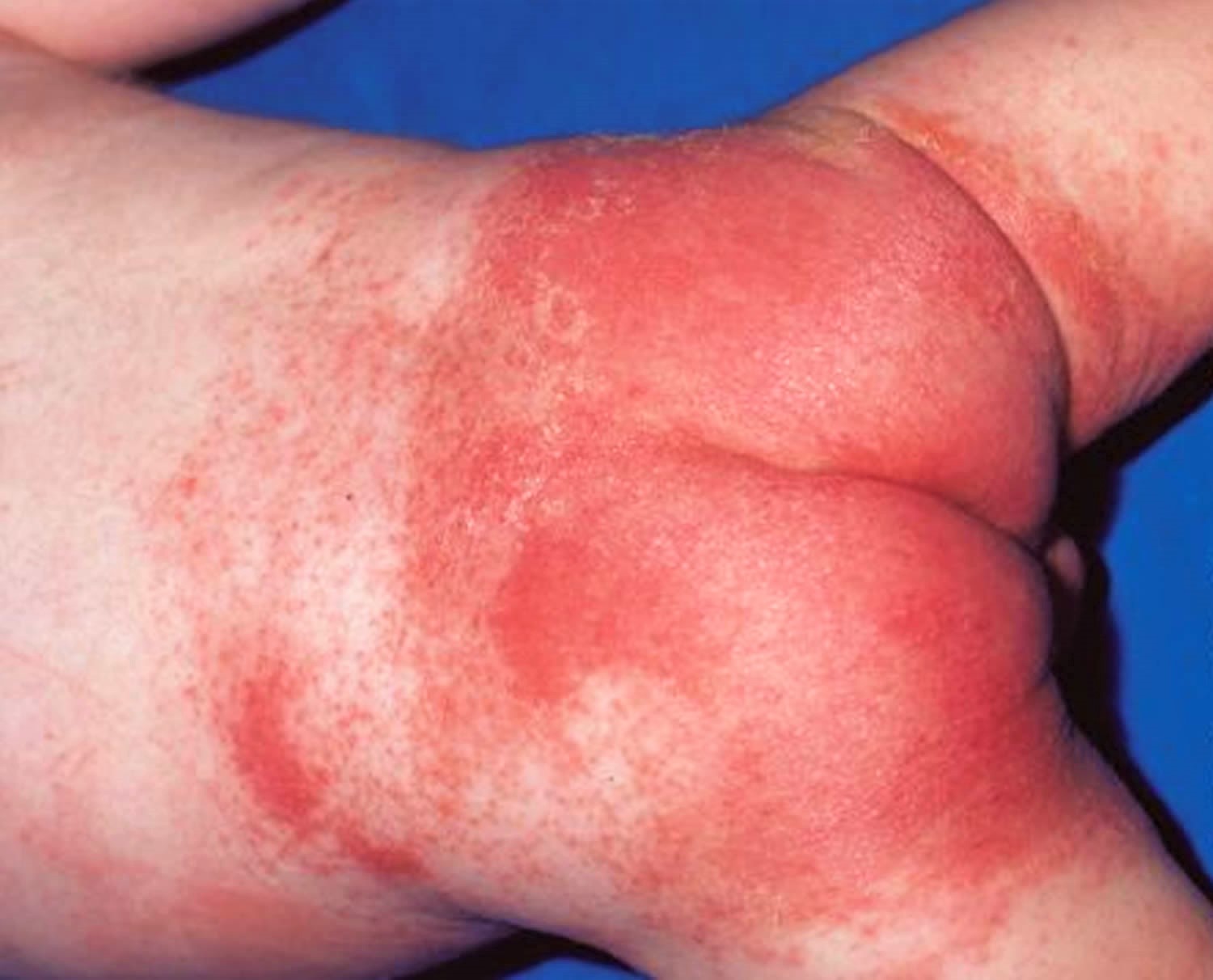 diaper rash