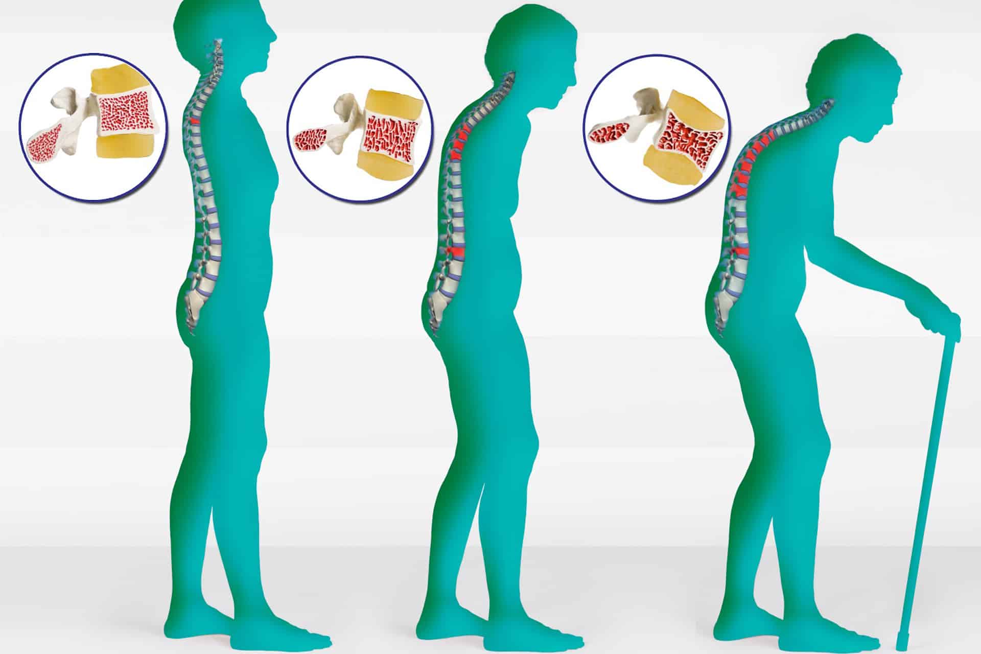 Osteoporosis Stages