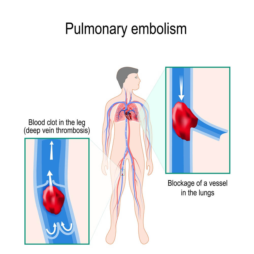 pulmonary embolism 910824652