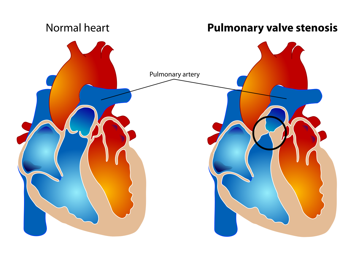 pulmonary stenosis 1