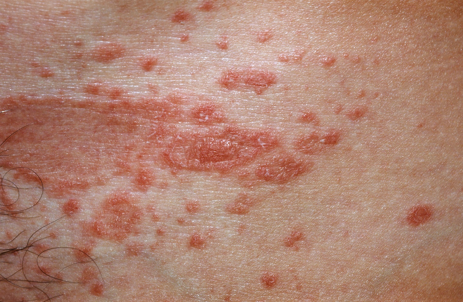 pityriasis rosea rash 2