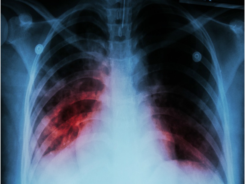 Silicosis