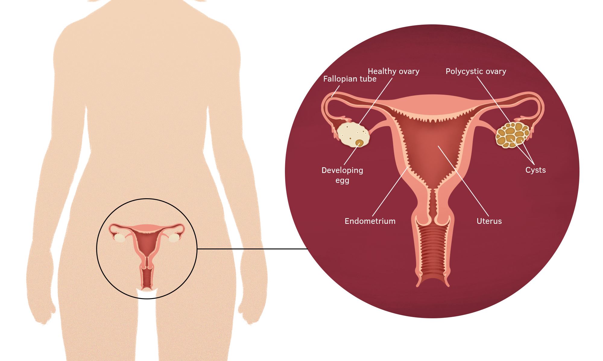 rp011 polycystic ovary syndrome au img1