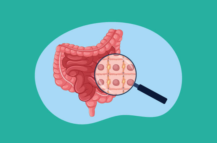 sakit radang usus bisa sebabkan proktitishalodoc