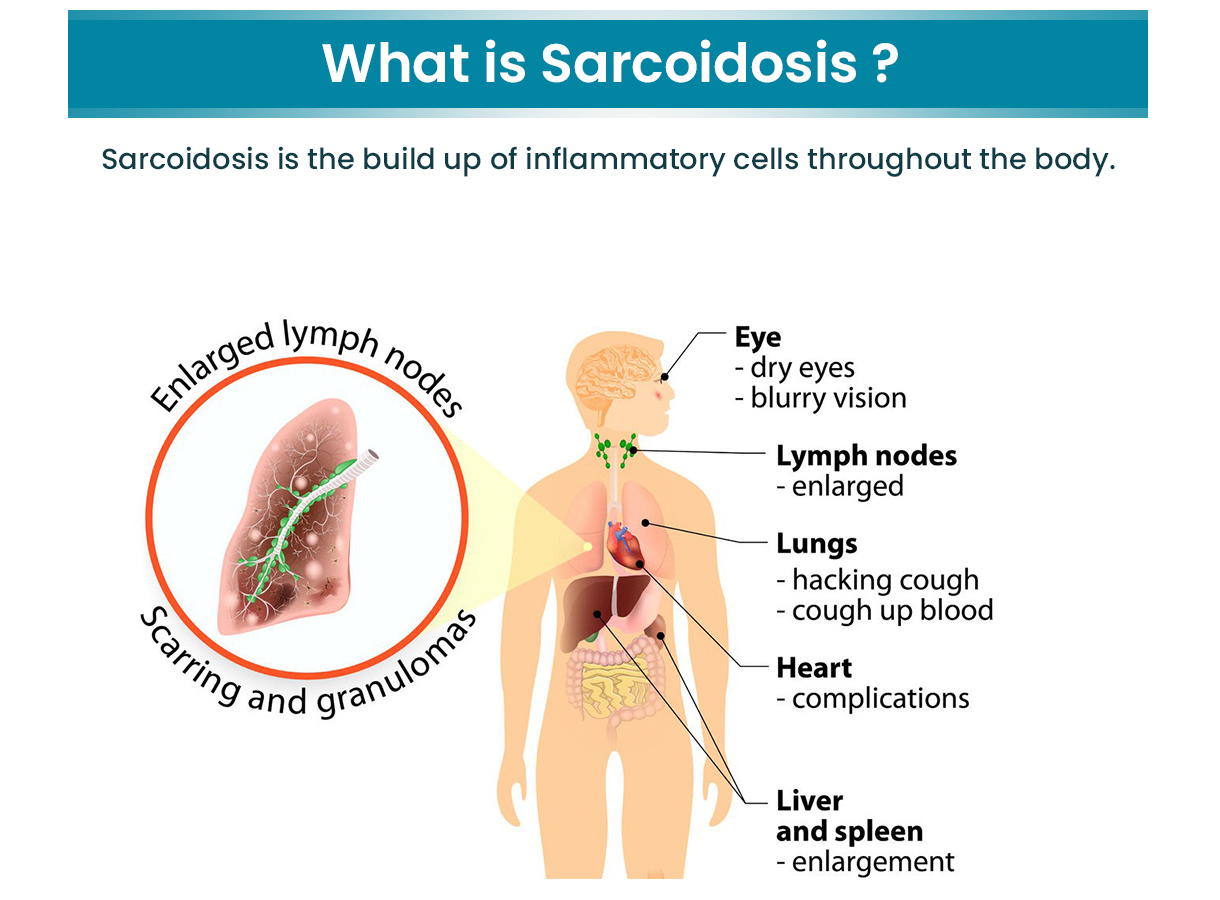 sarcoidosis main