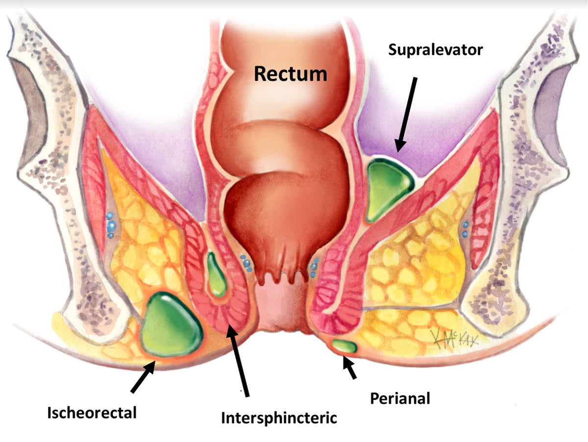 rectal abs 2
