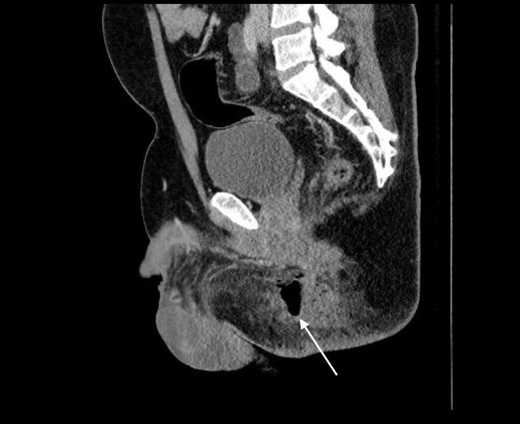 rectal abs 4