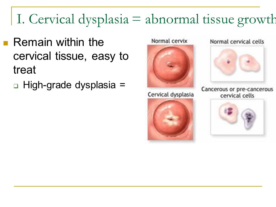 I.Cervicaldysplasiaabnormaltissuegrowth