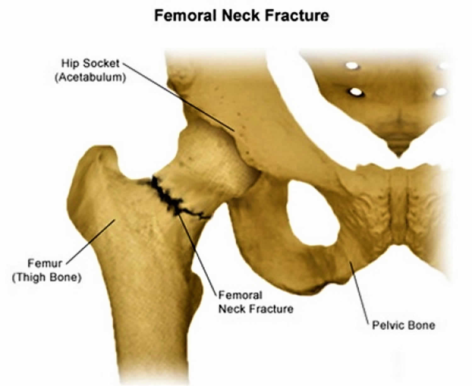 Femoral neck fracture