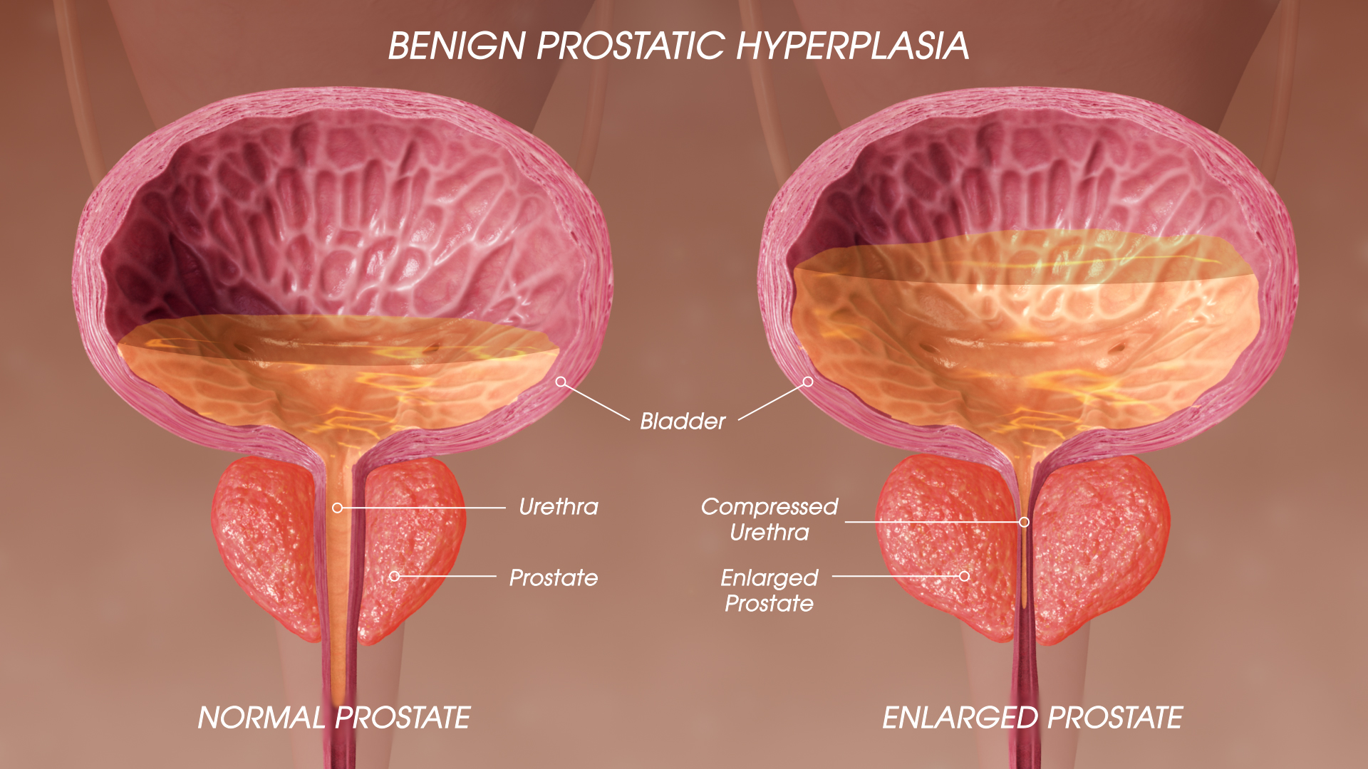 SAG Benign prostatic hyperplasia 190520 02