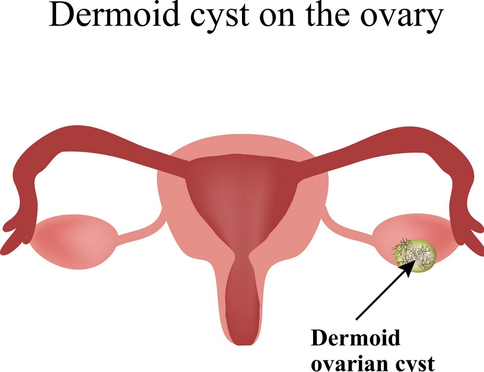 dermoid cyst on the ovary ovary infographics vector 9281091