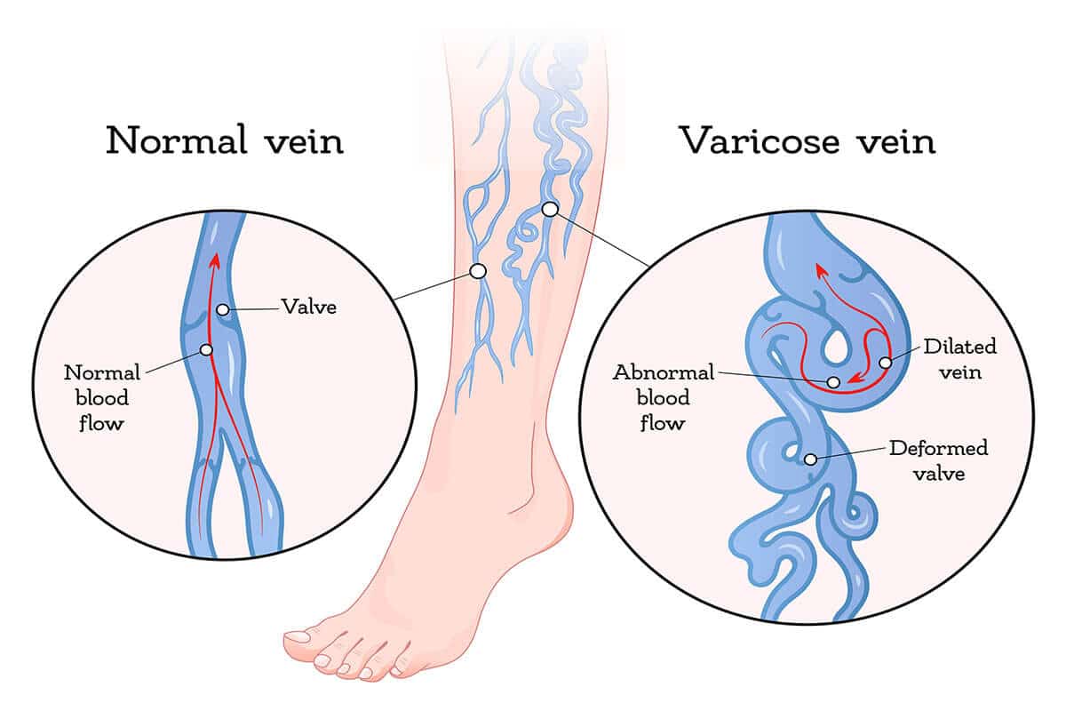 varicosecause 800 July2019 1.jpg 1