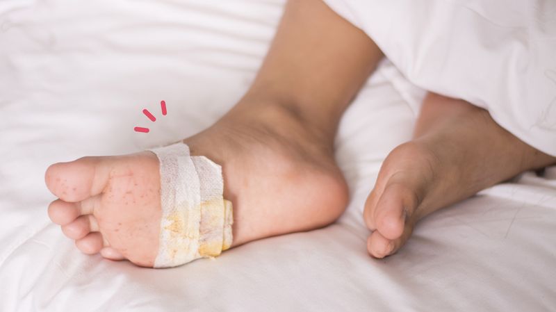 pyoderma gangrenosum.width 800.jpegquality 80