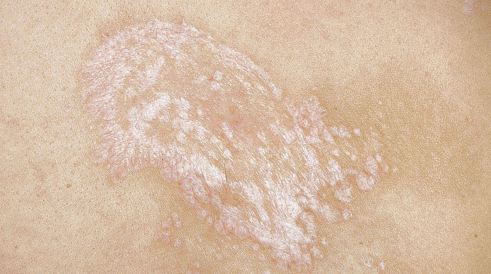 Lichen sclerosus
